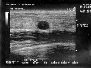 https://gyn.gr/artman/uploads/cyste.jpg