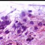 Ομάδα αδενικών κυττάρων με ανισοπυρήνωση