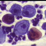 Επιφανειακά και διάμεσα πλακώδη επιθηλικά κύτταρα