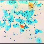 Αδενικών κυτταρων στο Pap-test