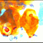 Υποτροπές κυτταρολογικών ατυπιών ερπητικής  αιτιολογίας, με συμπτωματολογία  κολπίτιδας