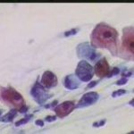 Κυτταρολογικές από HPV