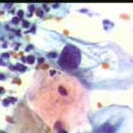 Γιγφνατιοκυττάρωση επιφ. κυττάρου, κοιλοκυττάρωση. 1997 