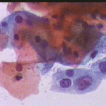 Οξεόφιλα πλακώδη επιθηλιακα κύτταρα. Παραβασικά κυτταρα με διογκωμενους ανισομεγέθεις πυρήνες. Καθαρό υπόστρωμα