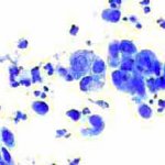 Ομάδες ομοιόμορφων  κυττάρων τοιχώματος κύστης μαστού. Πολυμορφοπύρηνα.. 