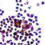 Φλεγμονής κύστεως μαστού