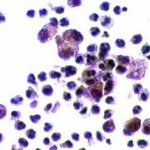 Kύτταρα τοιχώματος κύστης μαστού. Αφρώδη κύτταρα, άφθονα πολυμορφοπύρηνα.