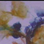 Υπερκεράτωση